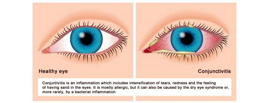 Conjunctivitis