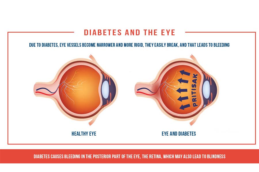 Diabetes can be the cause of cataracts on the eye