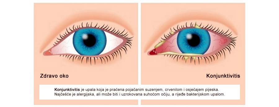 Konjunktivitis