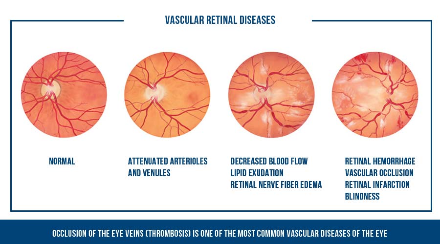 Vascular retinal diseases