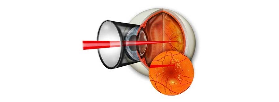 Ablation of the retina